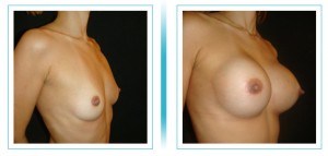 Breast Augmentation    