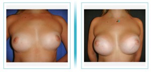 Breast Augmentation      