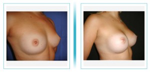 Breast Augmentation   