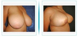 Breast Reduction   